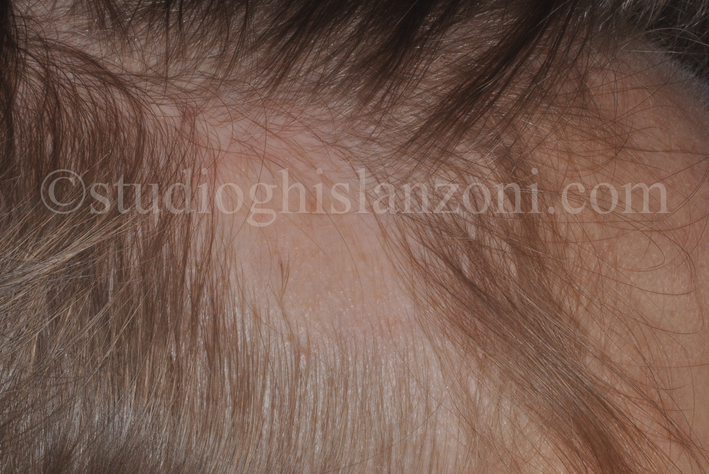Alopecia-triangolare-congenita.jpg