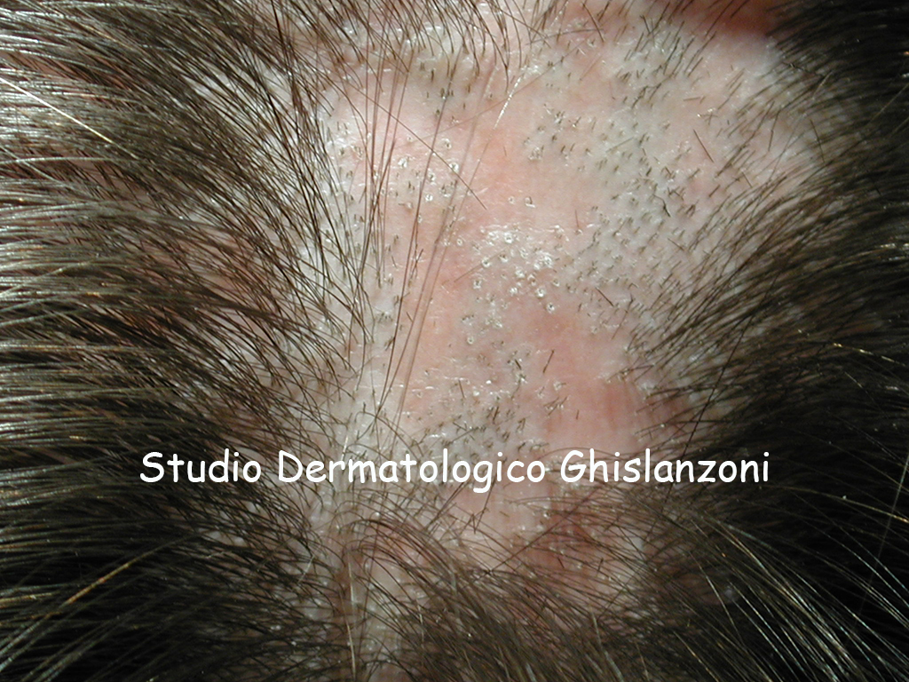 Alopecia cicatriziale.jpg
