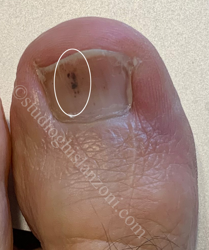 Emorragia a scheggia post-traumatica della parte distale dell'unghia del piede