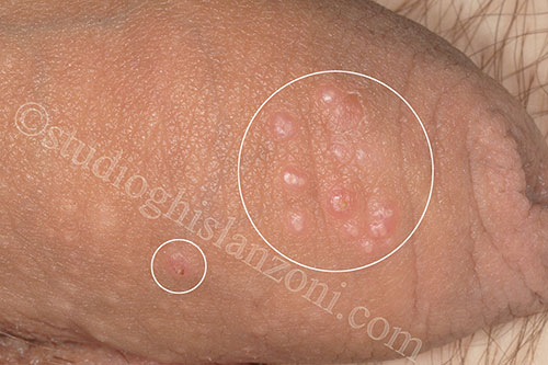 Herpes genitale pene