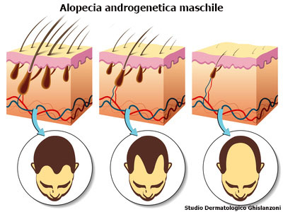 alopecia androgenetica maschile