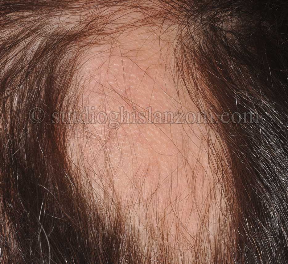 Alopecia areata in chiazze del capillizio