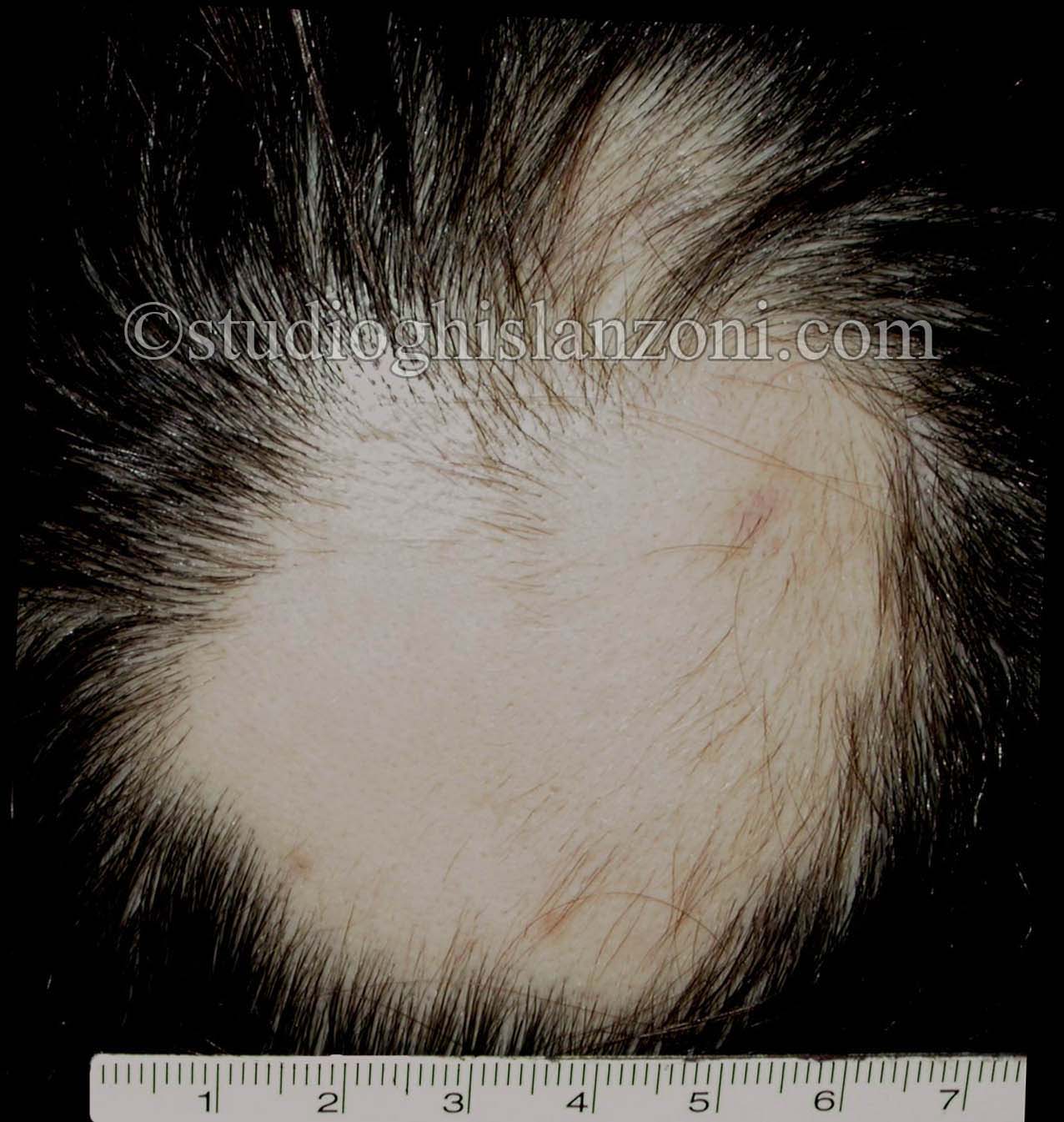 Alopecia-areata.jpg