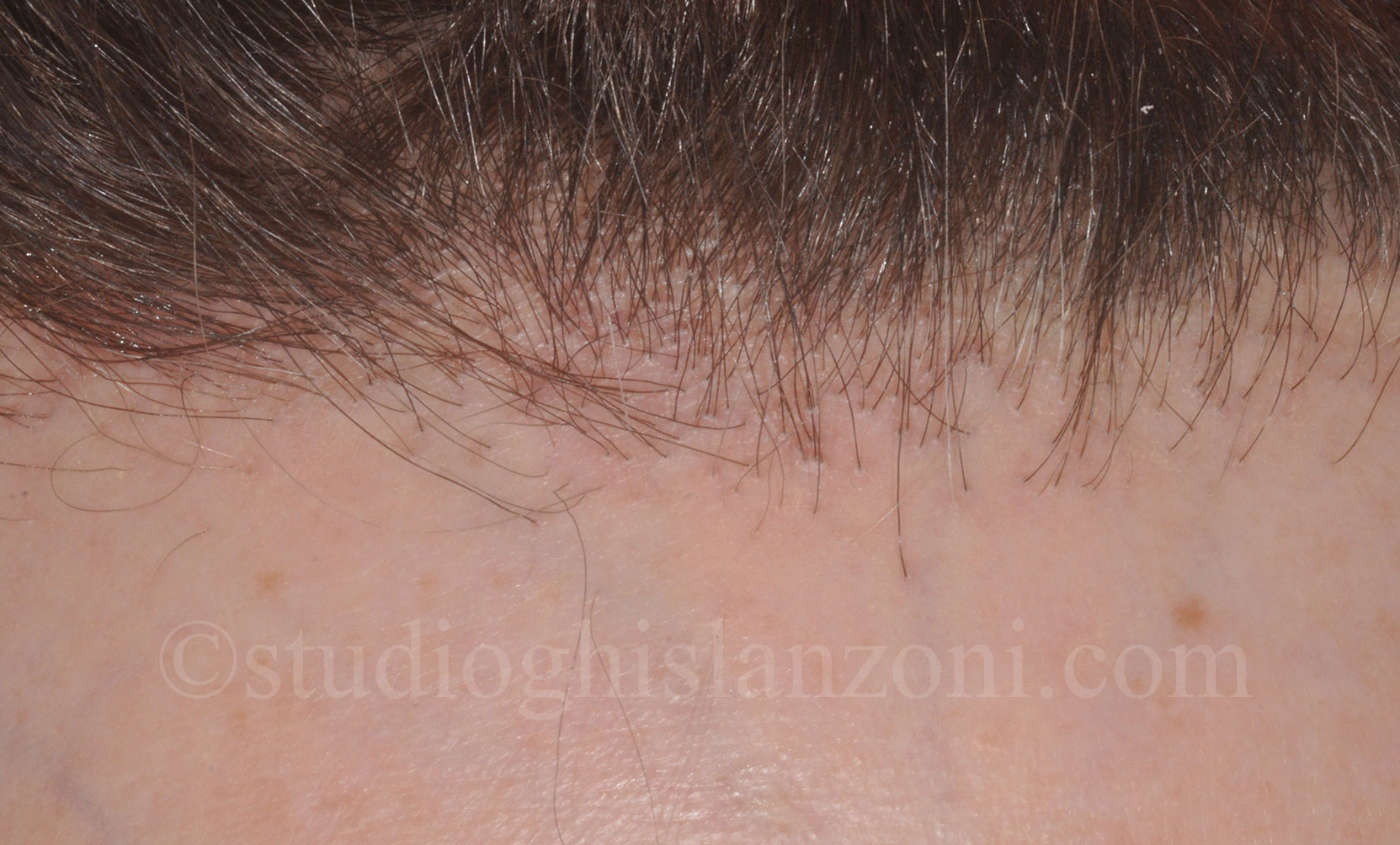 Alopecia-cicatriziale-Alopecia-fibrosante-frontale.jpg