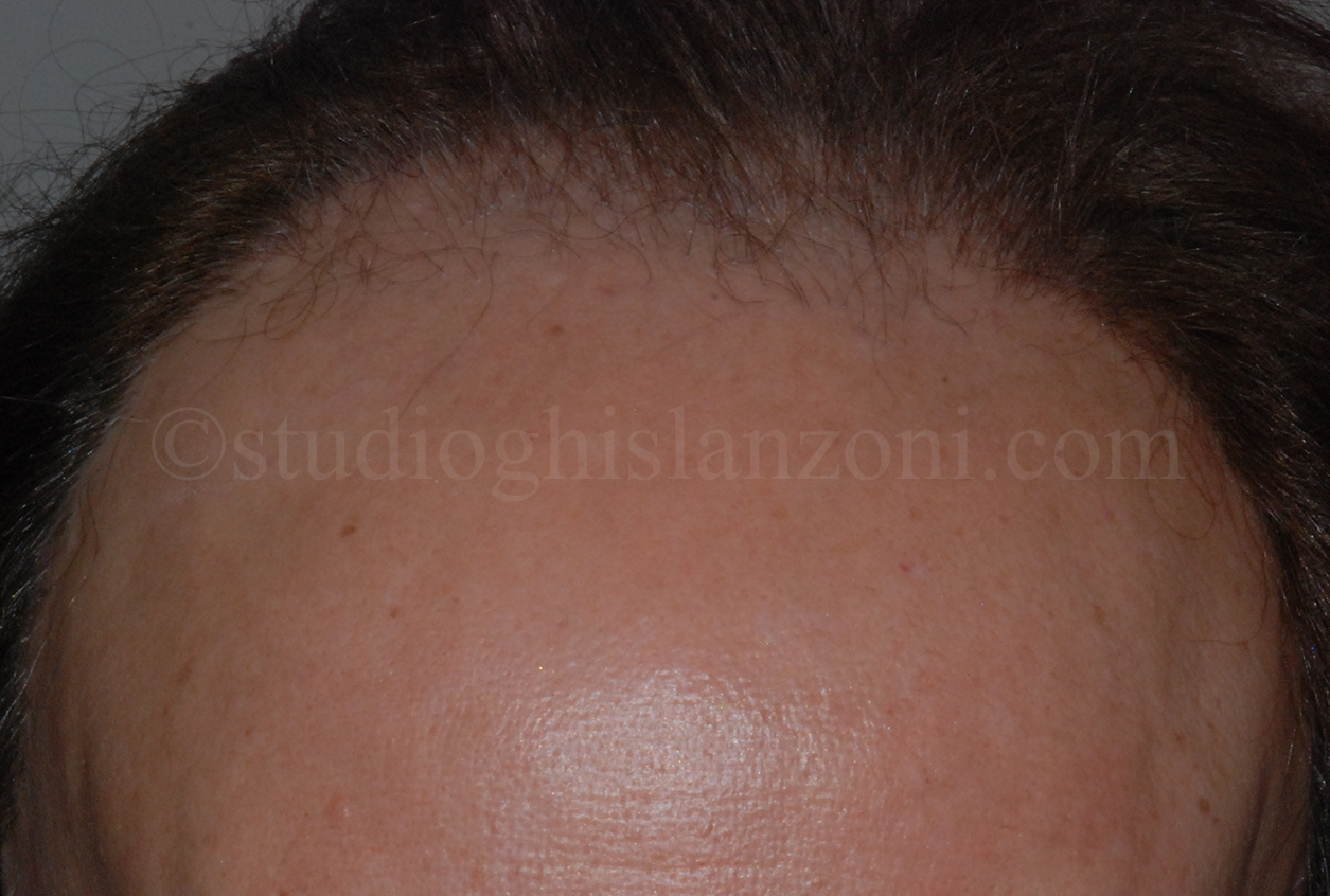 Alopecia-fibrosante-frontale.jpg