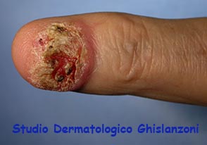 Carcinoma spinocellulare del dito