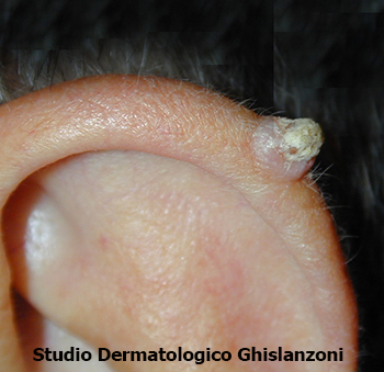 Carcinoma spinocellulare orecchio