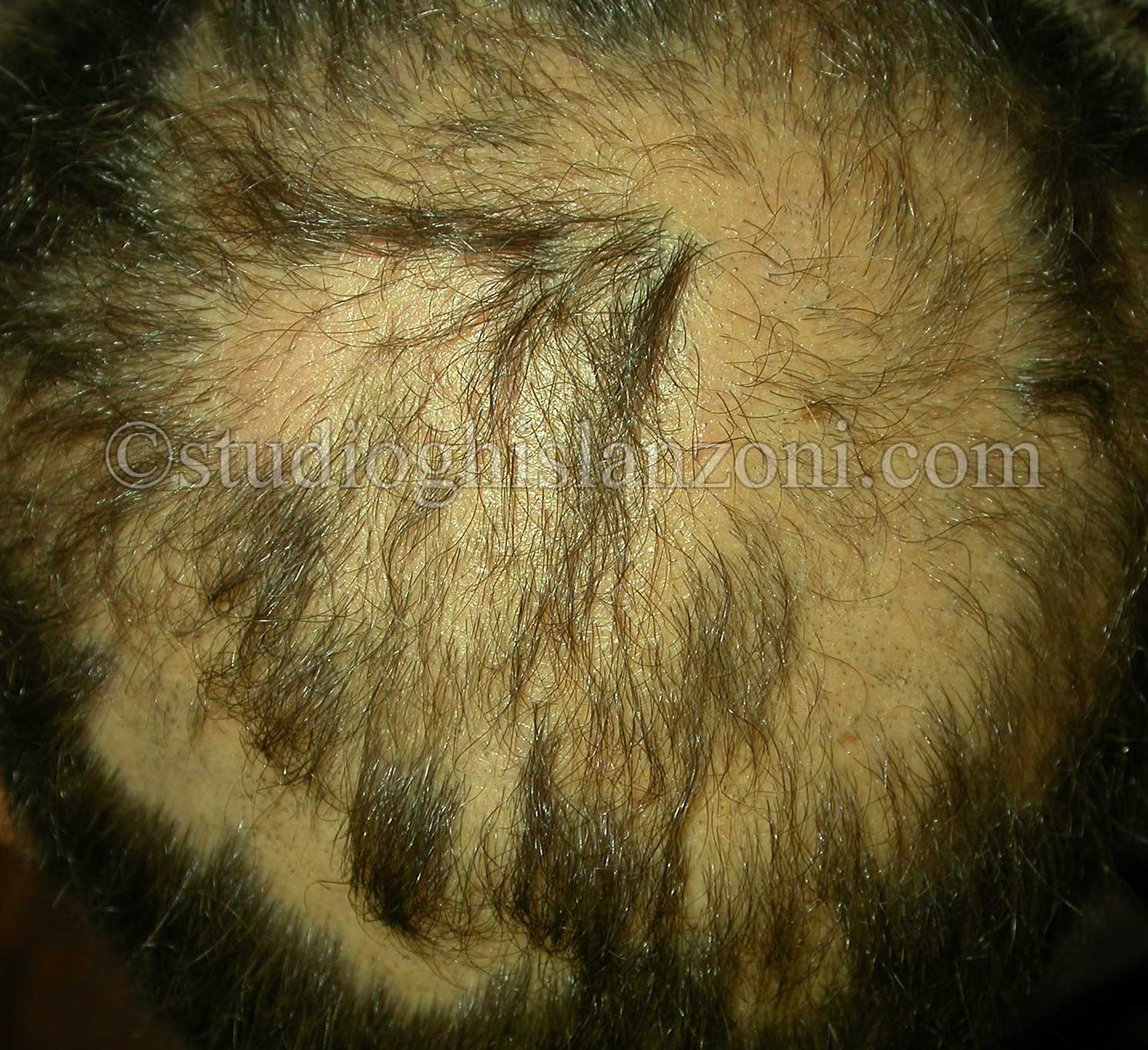 Chiazze-multiple-di-Alopecia-areata.jpg