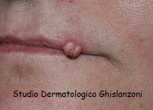 carcinoma spinocellulare labbra
