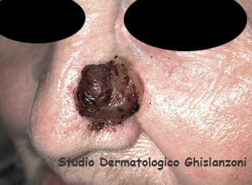 carcinoma spinocellulare naso