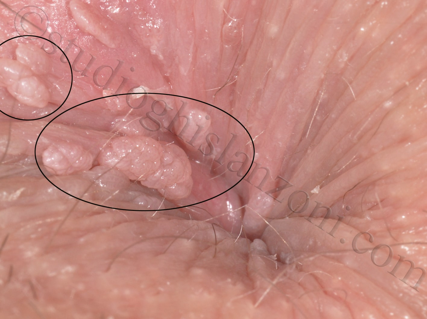 papilloma virus all ano sintomi creșterea pielii cu negi genitale