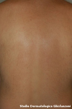 epilazione dor2