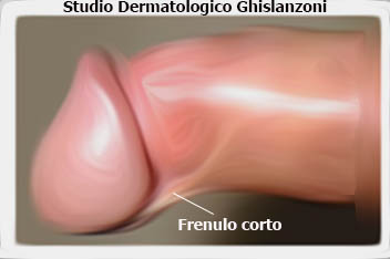 frenulo corto